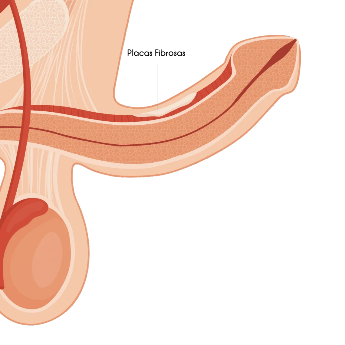DOENÇA DE PEYRONIE E 5 DÚVIDAS RECORRENTES SOBRE A DOENÇA 2 Doenca de Peyronie